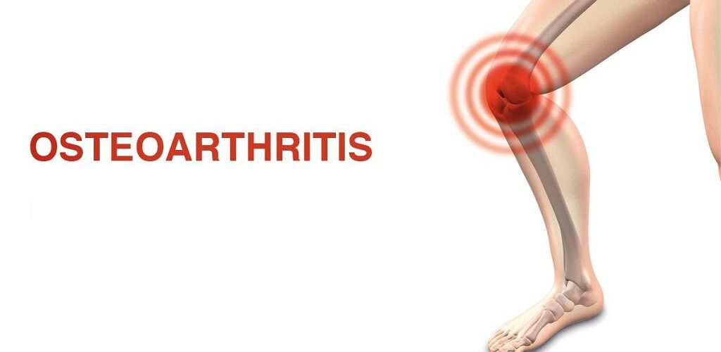 Home remedies for osteoarthritis