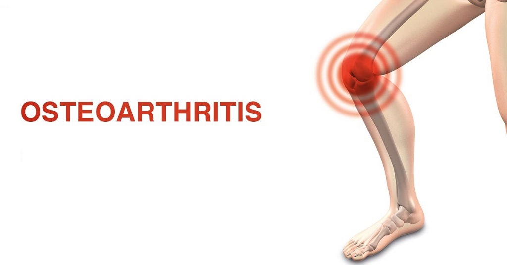remedies for osteoarthritis