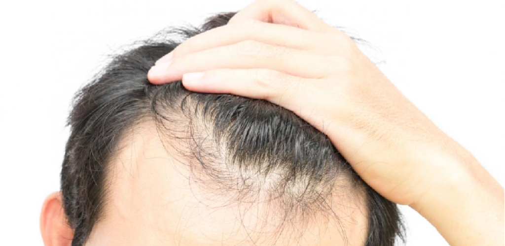 How to avoid or prevent hair loss: essential tips